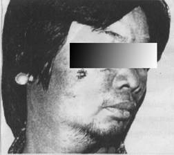 zoonosis Anthrax008