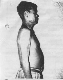zoonosis Anthrax012