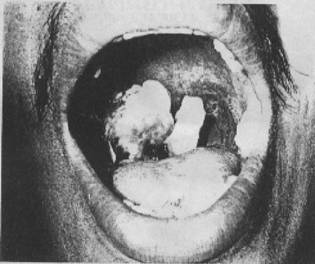 zoonosis Anthrax014